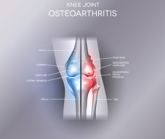 Knee Osteoarthritis Level 1