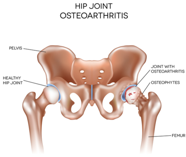 Hip Osteoarthritis Level 1